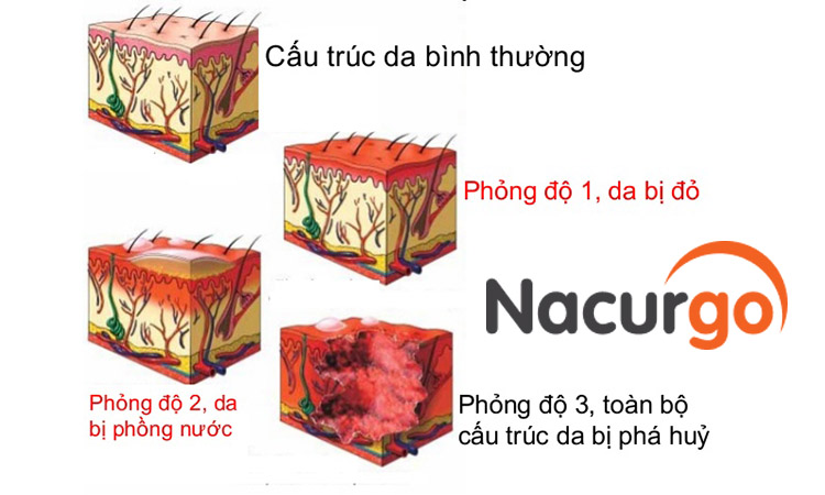 Các cấp độ bỏng cơ bản
