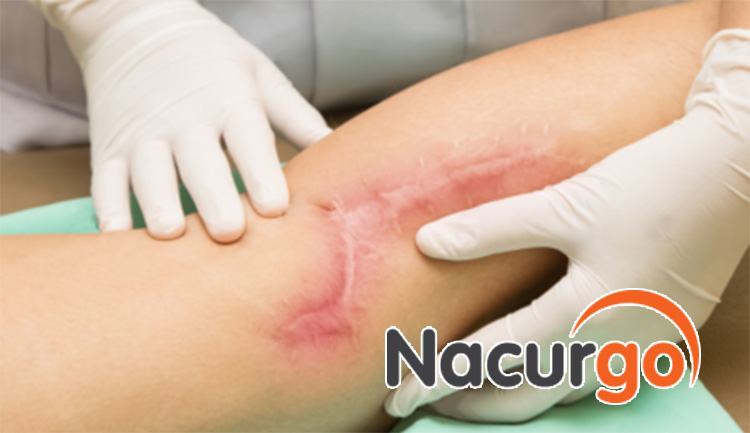 Hình ảnh vết bỏng thâm đỏ điển hình