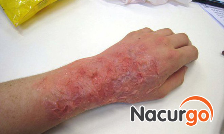 Nguyên nhân vết bỏng lâu lành có thể do nó bị nhiễm trùng