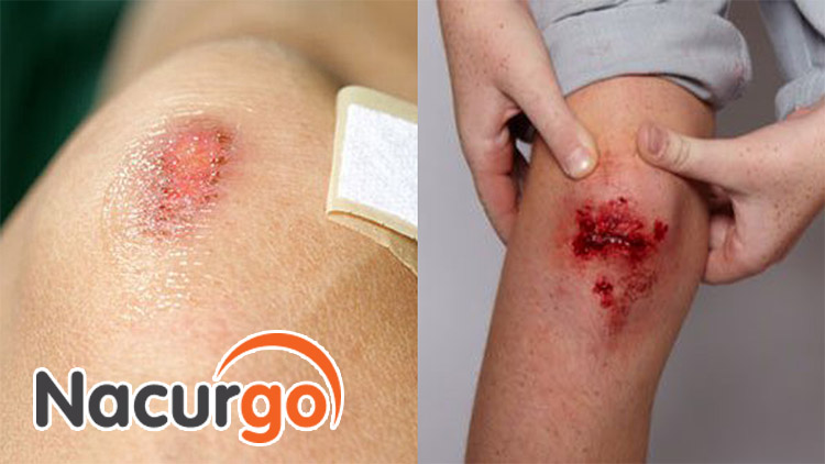 Có thể do vết trầy bị nhiễm trùng