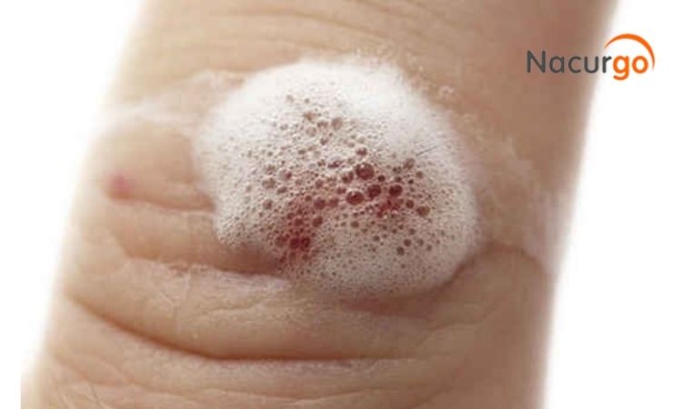 Không rửa vết thương bằng oxy già