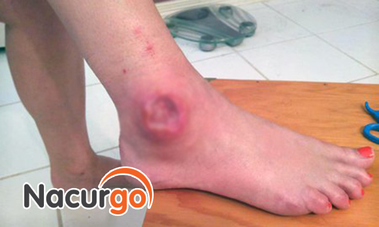 Vết thương bị nhiễm trùng nguy hiểm