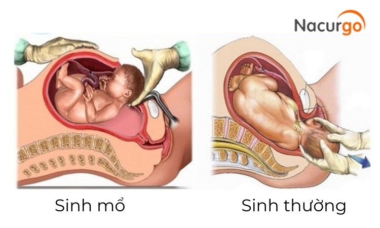 nguyen-nhan-vet-mo-nhiem-trung
