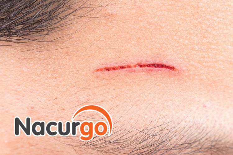 Vết thương có cơ chế lành lại nếu được chăm sóc tốt và không gây mủ viêm