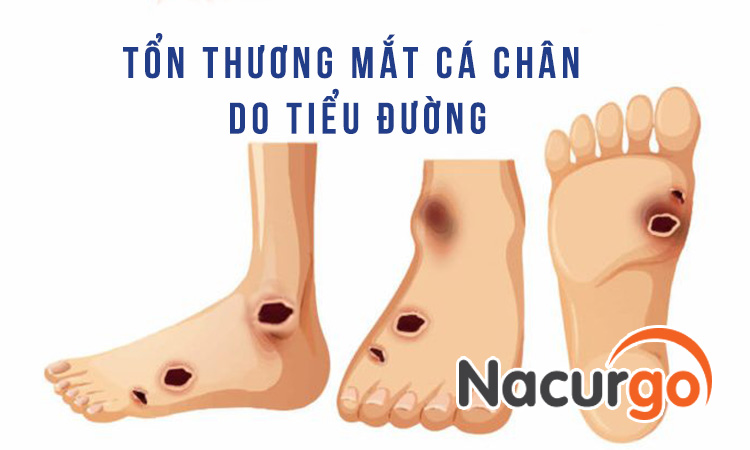 Tổn thương hở mắt cá chân do bệnh tiểu đường