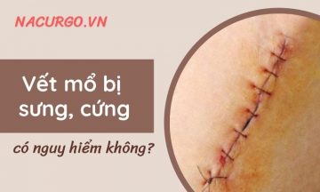 vet-mo-bi-sung-cung