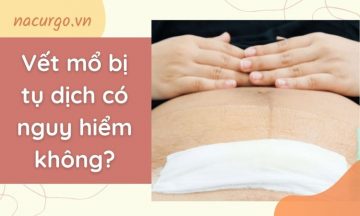 vet-mo-bi-tu-dich