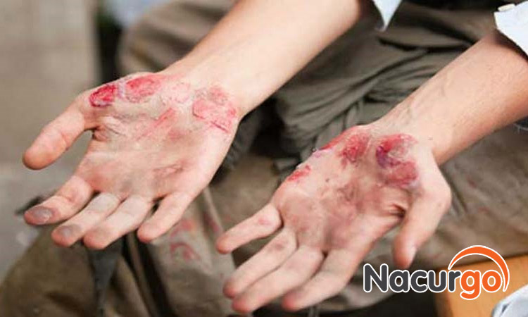Vết thương do té xe gây ra nhiều đau đớn