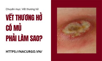 Vết thương hở có mủ phải làm sao?