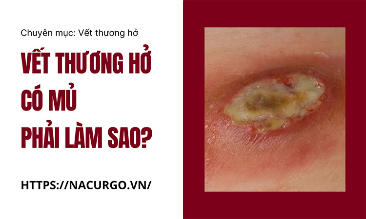 Vết thương hở có mủ phải làm sao?