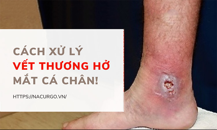 Xử lý vết thương hở ở mắt cá chân