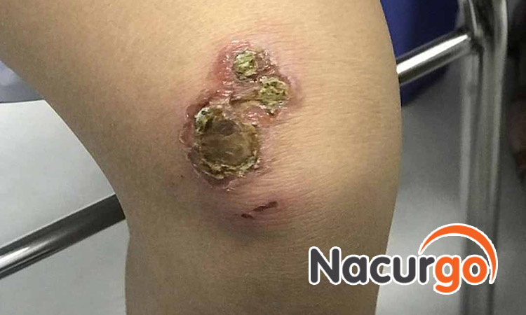 Vết thương hở có mủ là biểu hiện của nhiễm trùng vết thương