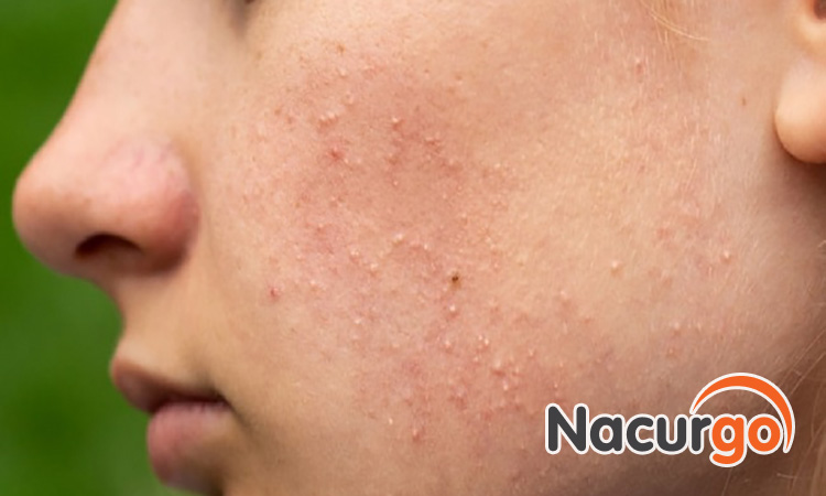 Hình ảnh mụn ẩn trên vùng da mặt