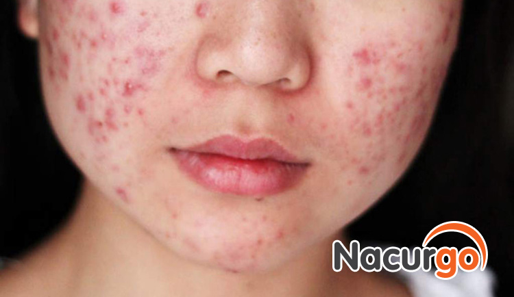 Nacurgo gel phù hợp cho đối tượng đang gặp các vấn đề về mụn như mụn viêm, mụn mủ, mụn đầu trắng, mụn đầu đen