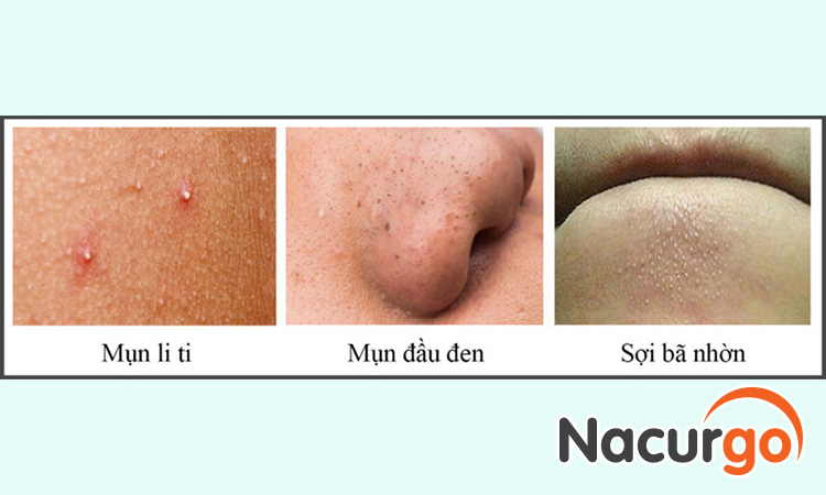 Đây là hình ảnh của mình trước khi sử dụng sản phẩm Nacurgo Gel