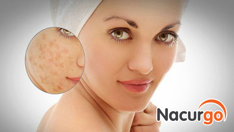 Sẹo thâm gây mất thẩm mỹ, ảnh hưởng đến tâm lý của nhiều chị em