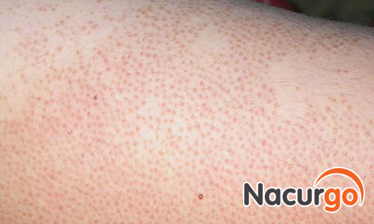 Kết quả điều trị viêm nang lông cũng cực kỳ hiệu quả